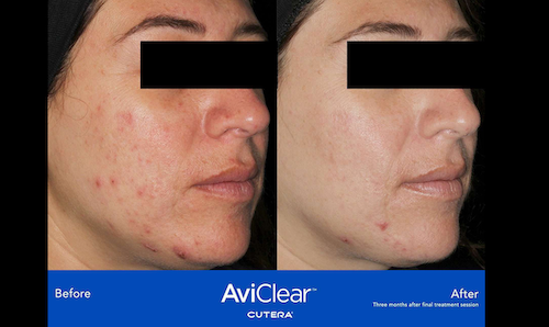 aviclear acne treatment before after mississauga oakville Lip Doctor